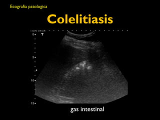 Colelitiasis 
gas intestinal 
Ecografia patologica 
 