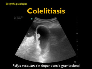 Ecografia patologica 
Colelitiasis 
Polipo vesicular: sin dependencia gravitacional 
 