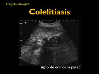 Colelitiasis 
signo de eco de la pared 
Ecografia patologica 
 
