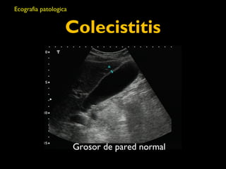 Colecistitis 
Grosor de pared normal 
Ecografia patologica 
 