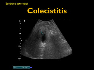Ecografia patologica 
Colecistitis 
 