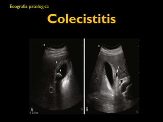 Ecografia patologica 
Colecistitis 
 