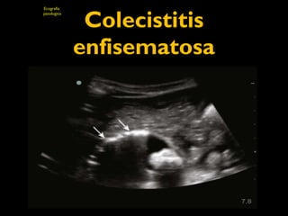 Colecistitis 
enfisematosa 
Ecografia 
patologica 
 