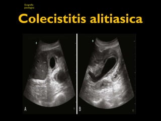 Ecografia 
patologica 
Colecistitis alitiasica 
 