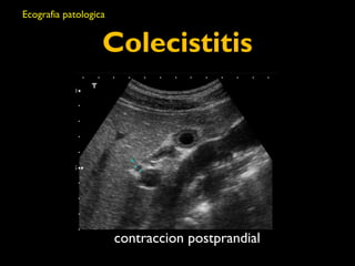 Colecistitis 
contraccion postprandial 
Ecografia patologica 
 