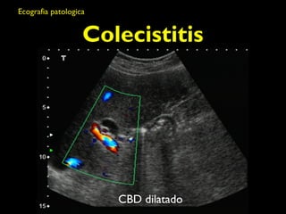 Colecistitis 
CBD dilatado 
Ecografia patologica 
 