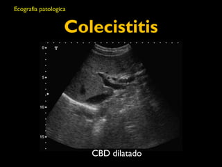 Colecistitis 
CBD dilatado 
Ecografia patologica 
 