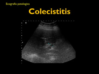 Ecografia patologica 
Colecistitis 
 
