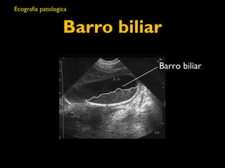 Barro biliar 
Barro biliar 
Ecografia patologica 
 