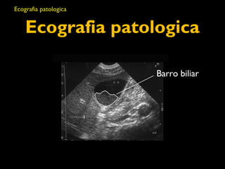Ecografia patologica 
Barro biliar 
Ecografia patologica 
 