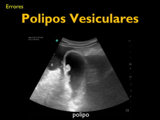 Errores 
Polipos Vesiculares 
polipo 
 