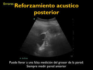 Reforzamiento acustico 
posterior 
Puede llevar a una falsa medición del grosor de la pared: 
Siempre medir pared anterior 
Errores 
 