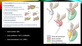 • Zona central : 25% 
• Zona periferica : 70 % ( CANCER ) 
• Zona trancisional : 5 % ( HPB ) 
 
