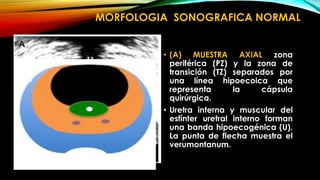 MORFOLOGIA SONOGRAFICA NORMAL 
• (A) MUESTRA AXIAL zona 
periférica (PZ) y la zona de 
transición (TZ) separados por 
una línea hipoecoica que 
representa la cápsula 
quirúrgica. 
• Uretra interna y muscular del 
esfínter uretral interno forman 
una banda hipoecogénica (U). 
La punta de flecha muestra el 
verumontanum. 
 