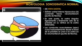 MORFOLOGIA SONOGRAFICA NORMAL 
• (B) VISTA SAGITAL 
• Esfínter uretral interno hipoecoica (U) 
corriendo hacia verumontanum 
(punta de flecha). 
 En este punto, la uretra ángulos 
ligeramente y finalmente sale de la 
próstata en su vértice en la uretra 
distal (DU). 
 Los conductos eyaculadores (ejac) 
curso horizontalmente desde la base 
de la próstata se unan a la uretra en 
la verumontarum (punta de flecha). 
 
