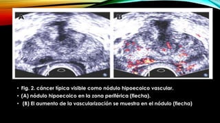 • Fig. 2. cáncer típica visible como nódulo hipoecoico vascular. 
• (A) nódulo hipoecoico en la zona periférica (flecha). 
• (B) El aumento de la vascularización se muestra en el nódulo (flecha) 
 