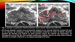 • Fig. 5. (A) Hay un pequeño nódulo posterior obvio cáncer hipoecoica (flecha). 
• (B) Power Doppler muestra que el pequeño nódulo no es vascular (flecha) a pesar de que 
es el cáncer; sin embargo, existe la vascularidad anormal en todo el lóbulo derecho 
(puntas de flecha) que indica un área mucho mayor de cáncer de isoecoicos. En 
retrospectiva en la Fig. 5A, hay cambios sutiles que sugieren cáncer en todo: todo el lóbulo 
derecho se amplía y deforme, y la cápsula quirúrgica se borra. 
 