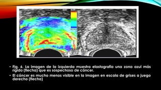 • Fig. 6. La imagen de la izquierda muestra elastografia una zona azul más 
rígido (flecha) que es sospechoso de cáncer. 
• El cáncer es mucho menos visible en la imagen en escala de grises a juego 
derecho (flecha) 
 