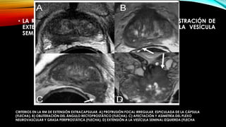 • LA RM HA DEMOSTRADO SER MÁS PRECISA EN LA DEMOSTRACIÓN DE 
EXTENSIÓN EXTRACAPSULAR Y LA PARTICIPACIÓN DE LA VESÍCULA 
SEMINAL Y TAMBIÉN PUEDE EVALUAR LINFADENOPATÍA 
CRITERIOS EN LA RM DE EXTENSIÓN EXTRACAPSULAR. A) PROTRUSIÓN FOCAL IRREGULAR, ESPICULADA DE LA CÁPSULA 
(FLECHA). B) OBLITERACIÓN DEL ÁNGULO RECTOPROSTÁTICO (FLECHA). C) AFECTACIÓN Y ASIMETRÍA DEL PLEXO 
NEUROVASCULAR Y GRASA PERIPROSTÁTICA (FLECHA). D) EXTENSIÓN A LA VESÍCULA SEMINAL IZQUIERDA (FLECHA 
 