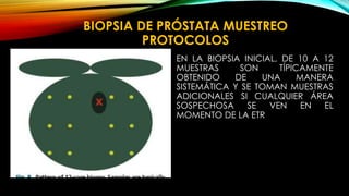 BIOPSIA DE PRÓSTATA MUESTREO 
PROTOCOLOS 
EN LA BIOPSIA INICIAL, DE 10 A 12 
MUESTRAS SON TÍPICAMENTE 
OBTENIDO DE UNA MANERA 
SISTEMÁTICA Y SE TOMAN MUESTRAS 
ADICIONALES SI CUALQUIER ÁREA 
SOSPECHOSA SE VEN EN EL 
MOMENTO DE LA ETR 
 