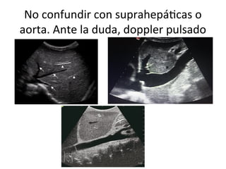 Evaluación Hemodinámica Integral Mediante Ecografía: Corazón, Vena Cava ...