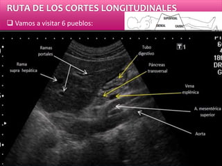 RUTA DE LOS CORTES LONGITUDINALES
 Vamos a visitar 6 pueblos:
2.- Aorta
 Aorta hasta la bifurcación
 Tronco celíaco
 Arteria mesentérica superior
 Estructura hepática
 Páncreas
 Estómago
 