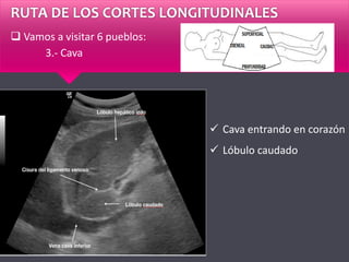 RUTA DE LOS CORTES LONGITUDINALES
 Vamos a visitar 6 pueblos:
3.- Cava
 Cava entrando en corazón
 Lóbulo caudado
 