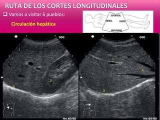 RUTA DE LOS CORTES LONGITUDINALES
 Vamos a visitar 6 pueblos:
Circulación hepática
Vasos portales: pared
Vasos suprahepáticos: sin pares
 
