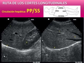RUTA DE LOS CORTES LONGITUDINALES
Circulación hepática: PP/SS
Vasos portales: pared
Vasos suprahepáticos: sin pares
 
