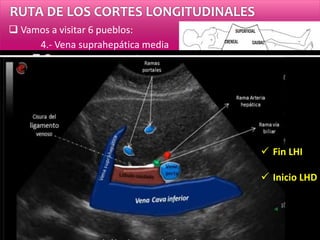 RUTA DE LOS CORTES LONGITUDINALES
 Vamos a visitar 6 pueblos:
4.- Vena suprahepática media
 Fin LHI
 Inicio LHD
 