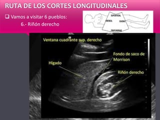 RUTA DE LOS CORTES LONGITUDINALES
 Vamos a visitar 6 pueblos:
6.- Riñón derecho
 