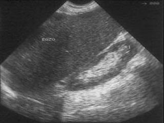 RUTA DE LOS CORTES LONGITUDINALES
 Vamos a realizar 2 excursiones:
1.- bazo y riñon izquierdo
 Línea axilar posterior izda
-altura de xifoidea
 Sonda en sentido costal a
las 2h
 Si bajamos un espacio
intercostal: riñon izdo
 