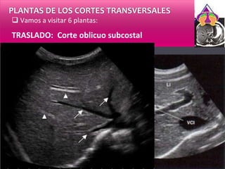 PLANTAS DE LOS CORTES TRANSVERSALES
 Vamos a visitar 6 plantas:
TRASLADO: Corte oblicuo subcostal
 