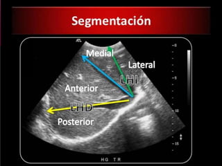PLANTAS DE LOS CORTES TRANSVERSALES
 SEGMENTACIÓN HEPÁTICA
 Para segmentar el hígado:
 SHD: el LHD en anterior y posterior
 SHM: lóbulo hepático derecho e izquierdo
 SHI: LHI en medial y lateral
 