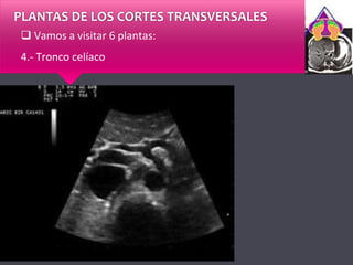 PLANTAS DE LOS CORTES TRANSVERSALES
 Vamos a visitar 6 plantas:
4.- Tronco celíaco
 