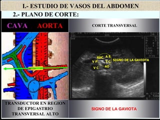I.- ESTUDIO DE VASOS DEL ABDOMEN
AORTA
23 mm
vertebra
S A P
V. PORTA
(11-13 mm)
TRONCO
CELIACO
(5-10 mm)
ART
ESPLENICA
<5 mm
COLEDOCO
4 mm
ART HEPATICA COMUN (2-6 mm)
CORTE TRANSVERSAL
SIGNO DE LA GAVIOTA
CAVA - AORTA
TRANSDUCTOR EN REGION
DE EPIGASTRIO
TRANSVERSAL ALTO
AO
T C
A E
V C
V P
AHC
SIGNO DE LA GAVIOTA
2.- PLANO DE CORTE:
 