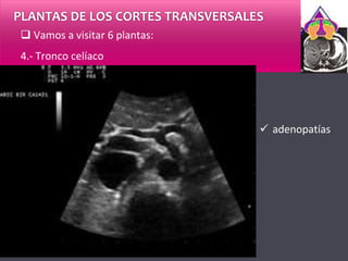  adenopatías
PLANTAS DE LOS CORTES TRANSVERSALES
 Vamos a visitar 6 plantas:
4.- Tronco celíaco
 