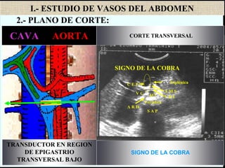 I.- ESTUDIO DE VASOS DEL ABDOMEN
vertebra
S A P
CORTE TRANSVERSAL
SIGNO DE LA COBRA
CAVA - AORTA
TRANSDUCTOR EN REGION
DE EPIGASTRIO
TRANSVERSAL BAJO
AMS
VENA
ESPLENICA
CONFLUENCIA
ESPLENO-PORTAL
VENA
RENAL
IZQUIERDA
AORTA
ARTERIA
RENAL
DERECHA
S A P
A R D
Vertebra
V R I
A M S
AOV C
C E P V Esplénica
SIGNO DE LA COBRA
2.- PLANO DE CORTE:
 