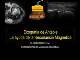 Ecografía de Antepie
La ayuda de la Resonancia Magnética
Dr. Rafael Barousse
Departamento de Musculo Esquelético
 