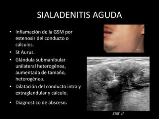 SIALADENITIS AGUDA
• Inflamación de la GSM por
estenosis del conducto o
cálculos.
• St Aurus.
• Glándula submanibular
unilateral heterogénea,
aumentada de tamaño,
heterogénea.
• Dilatación del conducto intra y
extraglandular y cálculo.
• Diagnostico de absceso.
 