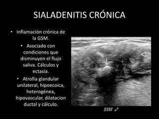SIALADENITIS CRÓNICA
• Inflamación crónica de
la GSM.
• Asociado con
condiciones que
disminuyen el flujo
saliva. Cálculos y
ectasia.
• Atrofia glandular
unilateral, hipoecoica,
heterogénea,
hipovascular, dilatacion
ductal y cálculo.
 
