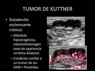 TUMOR DE KUTTNER
• Sialadenitis
esclerosante
crónica:
– Glándula
hipoecogénica,
nódulosheterogén
eoas de apariencia
cirrótica bilateral.
– Condición similar a
un tumor de las
GSM > Parotidas.
 