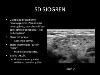 SD SJOGREN
• Glándulas difusamente
hipoecogénicas, Parénquima
heterogéneo, reticulado difuso
con septos hipoecoicos. “ Piel
de Leopardo”
• Etapa temprana:
– Apariencia normal.
• Etapa intermedia: “patrón
miliar”:
– Múltiples microquistes.
• ETAPA TARDÍA:
– Grandes quistes y masas
sólidas en parótidas y GSM.
 
