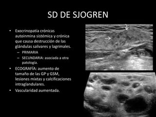 SD DE SJOGREN
• Exocrinopatía crónicas
autoinmina sistémica y crónica
que causa destrucción de las
glándulas salivares y lagrimales.
– PRIMARIA
– SECUNDARIA: asociada a otra
patología.
• ECOGRAFÍA: aumento de
tamaño de las GP y GSM,
lesiones mixtas y calcificaciones
intraglandulares.
• Vascularidad aumentada.
 