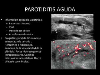 PAROTIDITIS AGUDA
• Inflamación aguda de la parótida.
– Bacteriano (absceso)
– Viral
– Inducido por cálculo
– AI: enfermedad crónica.
• Ecografía: glándula difusamente
aumentada de tamaño .
Herogénea e hipoecoica,
aumento de la vascularidad de la
glándula. Focos hiperecogénicos
intraglandulares. Ganglios
linfáticos intraparotideos. Ducto
dilatado con cálculos.
 