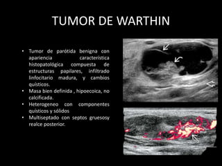 TUMOR DE WARTHIN
• Tumor de parótida benigna con
apariencia característica
histopatológica compuesta de
estructuras papilares, infiltrado
linfocitario madura, y cambios
quísticos.
• Masa bien definida , hipoecoica, no
calcificada.
• Heterogeneo con componentes
quísticos y sólidos
• Multiseptado con septos gruesosy
realce posterior.
 