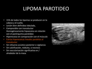 LIPOMA PAROTIDEO
• 15% de todos los lipomas se producen en la
cabeza y el cuello.
• Lesión bien definidoa lobulada,
• Compresible con transductor
Homogéneamente hipoecoica en relación
con el parénquima parotideo
• Hiperecoico en comparación con el músculo
• Estrías hiperecoicas lineales paralelas al
transductor
• Sin refuerzo acústico posterior o vigilancia
• Sin calcificación, nódulos, o necrosis
• Sin vascularización significativa en /
alrededor de la masa
 