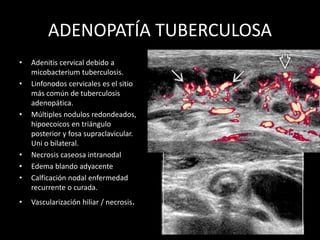 ADENOPATÍA TUBERCULOSA
• Adenitis cervical debido a
micobacterium tuberculosis.
• Linfonodos cervicales es el sitio
más común de tuberculosis
adenopática.
• Múltiples nodulos redondeados,
hipoecoicos en triángulo
posterior y fosa supraclavicular.
Uni o bilateral.
• Necrosis caseosa intranodal
• Edema blando adyacente
• Calficación nodal enfermedad
recurrente o curada.
• Vascularización hiliar / necrosis.
 