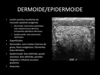 DERMOIDE/EPIDERMOIDE
• Lesión quística resultante de
inclusión epitelial congénita
– Dermoide: elementos epiteliales
más subestructura dérmica
incluyendo apéndices dérmicos
– Epidermoide: solo elementos
epiteliales.
• Superficiales.
• Dermoides: ecos mixtos internos de
grasa, focos ecogénicos. Elementos
óseo-dentales.
• Epidermoide: bien definido, quiste
anecoico, bien definido, paredes
delgadas y refuerzo acustico
posterior.
• Avascular.
 