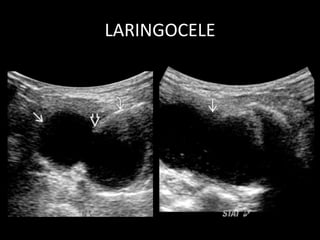 LARINGOCELE
 